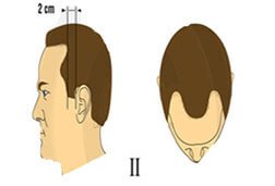 TYPE 2