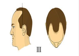 TYPE 3