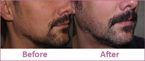 Beard and Mustache Hair Transplant