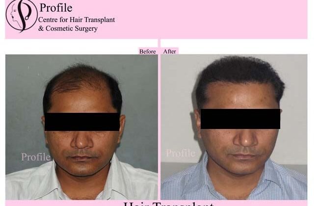 After hair restoration surgery- Discomfort & Pain