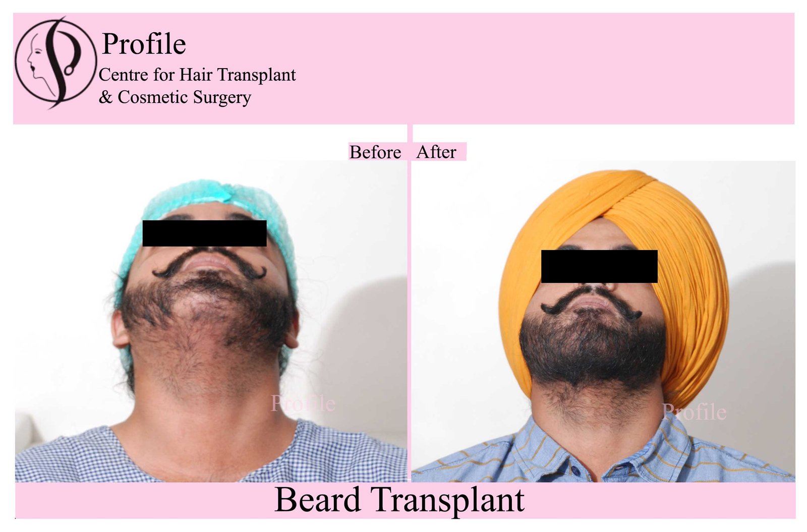 beard-ht