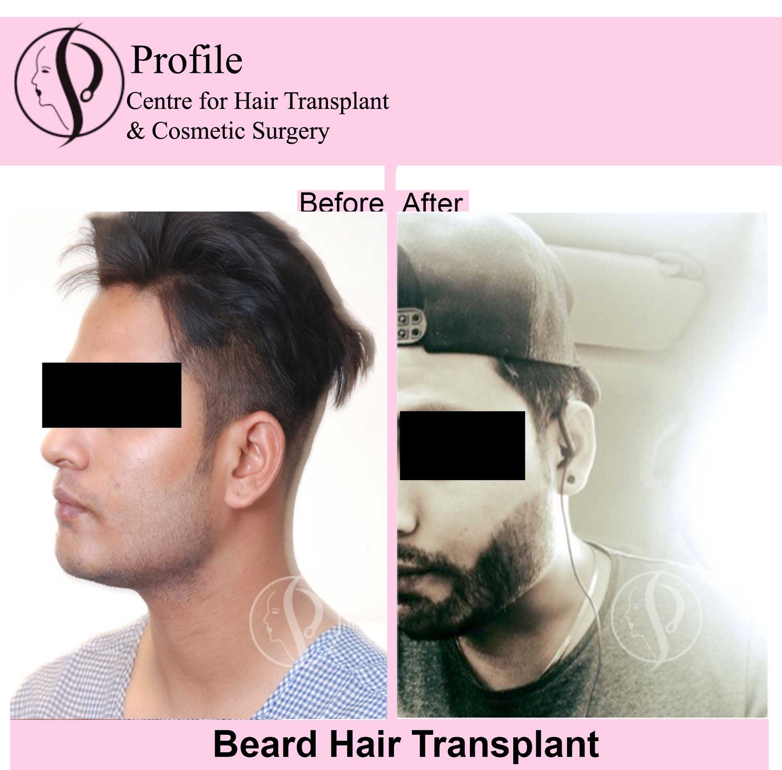 gp-beard-result11