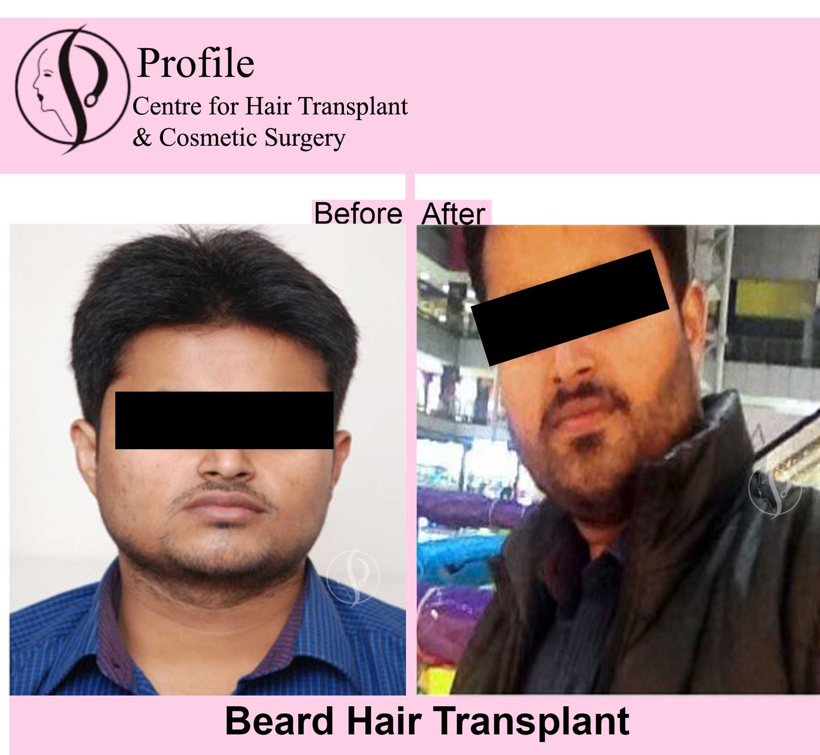 kunal-beard11