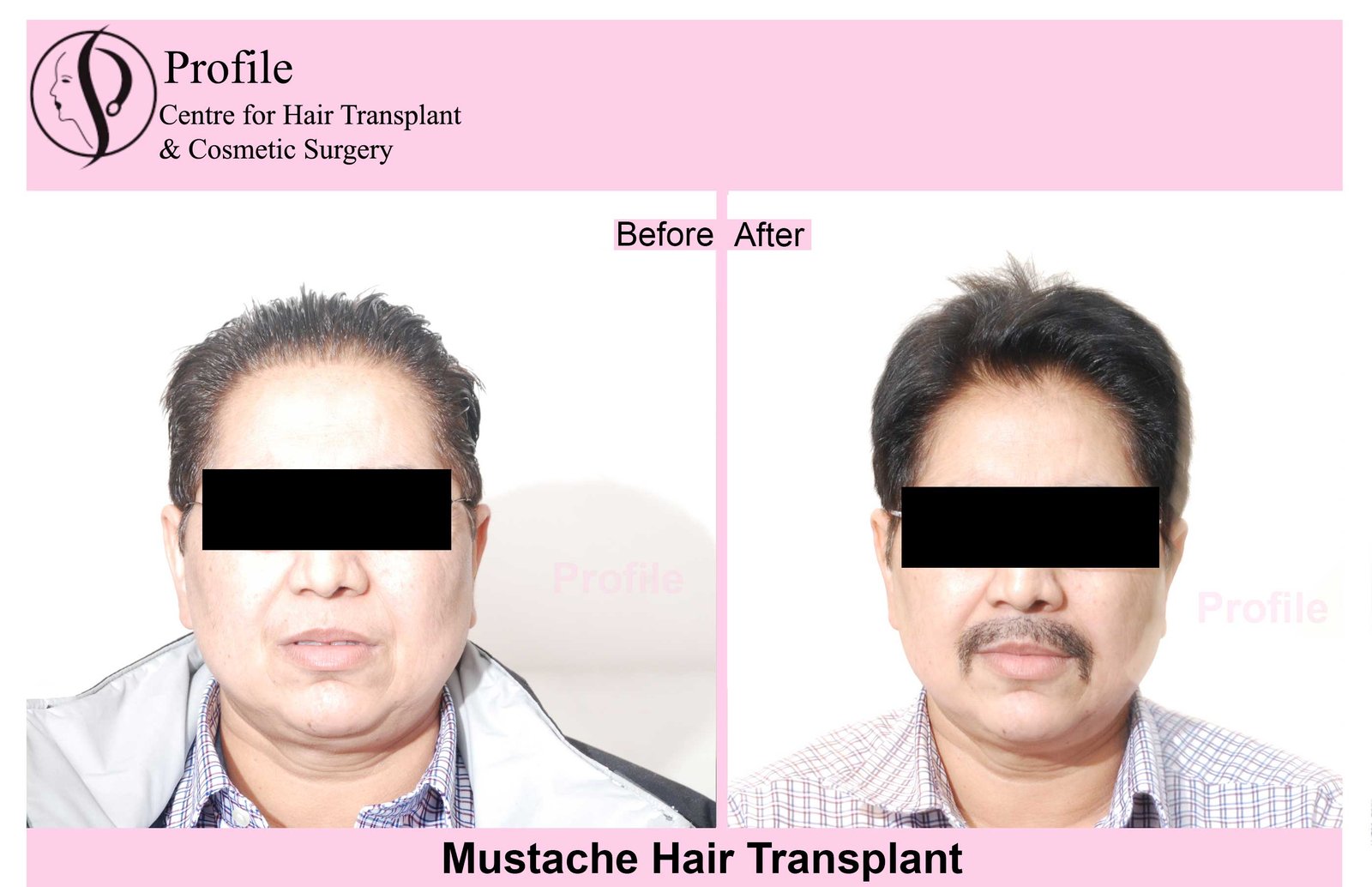 mustache-hair11