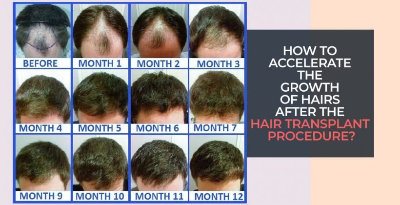 How to accelerate the growth of hairs after the Hair transplant procedure
