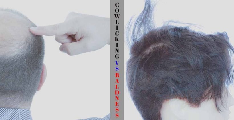 Balding & Cowlicking: What’s the difference & Is there any need to worry?