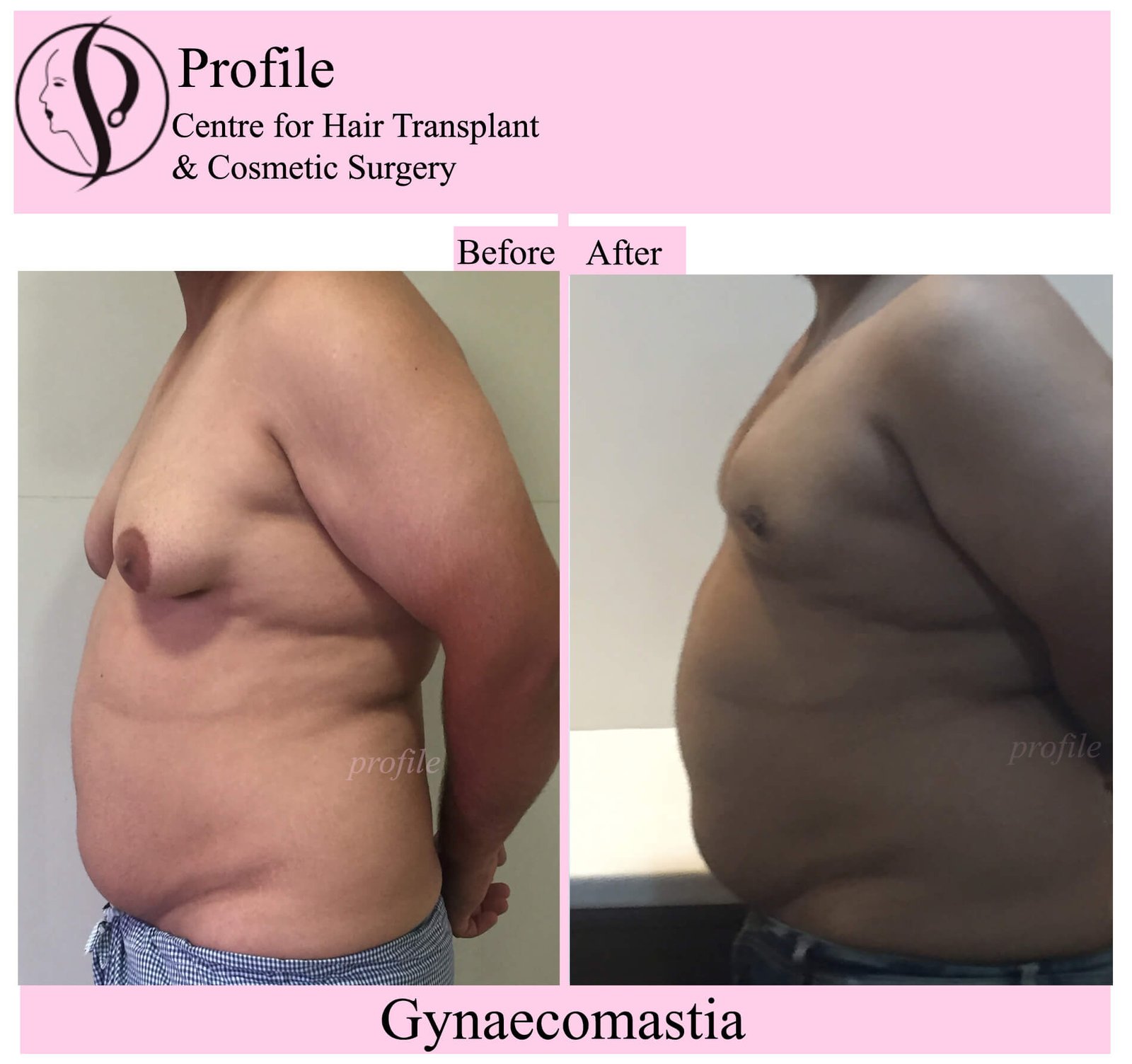gynaecomastia11