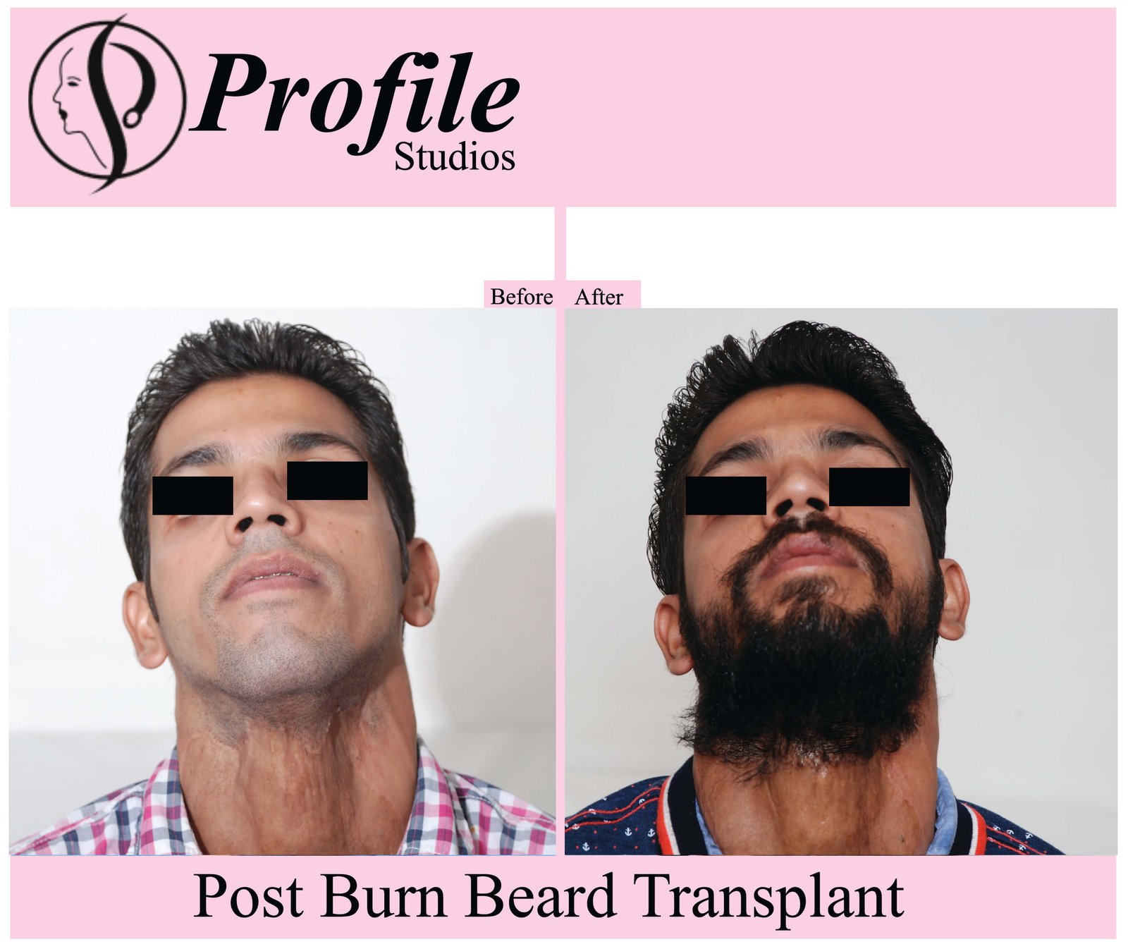 sachinpostburn1