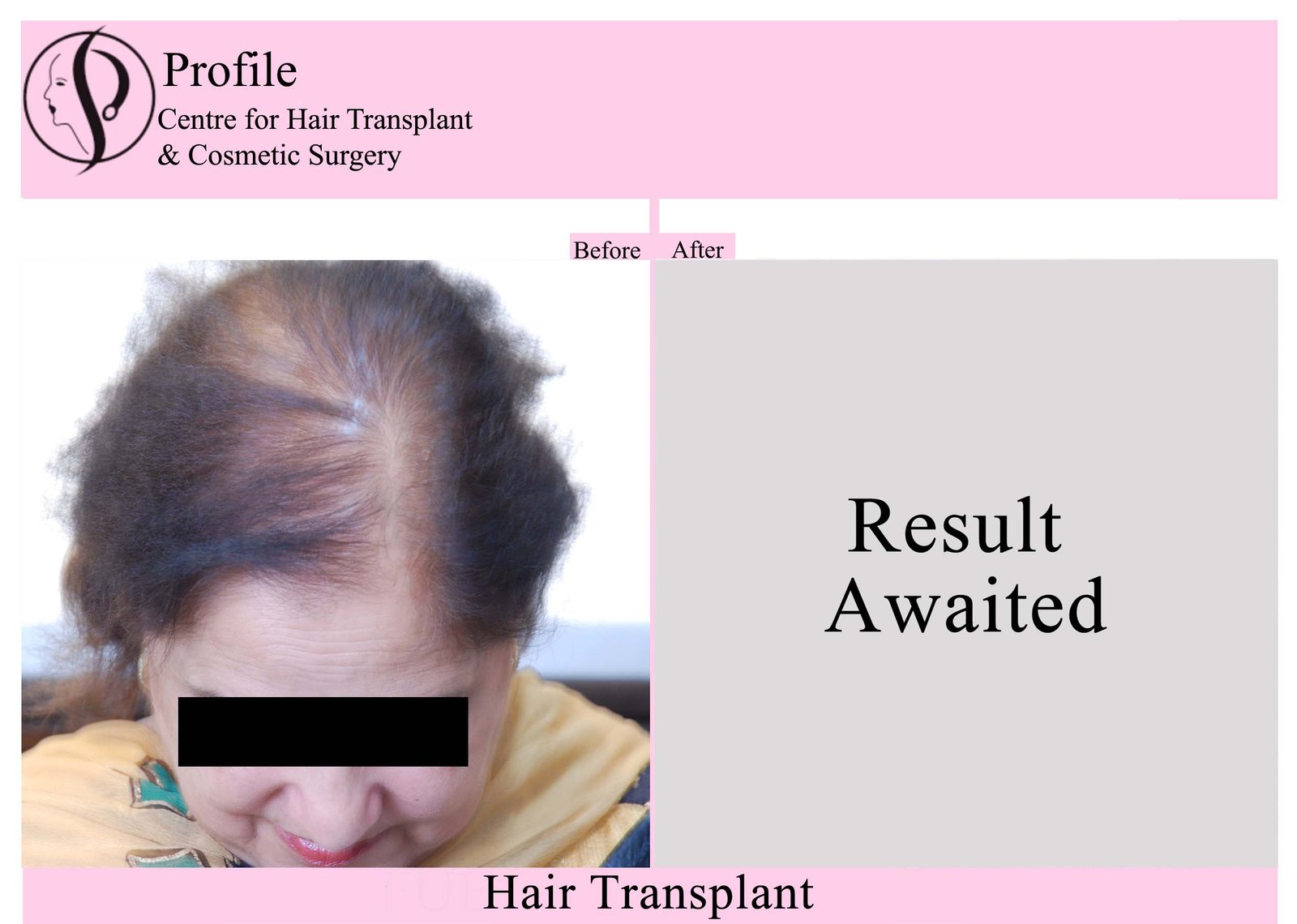 Female Hair Transplant