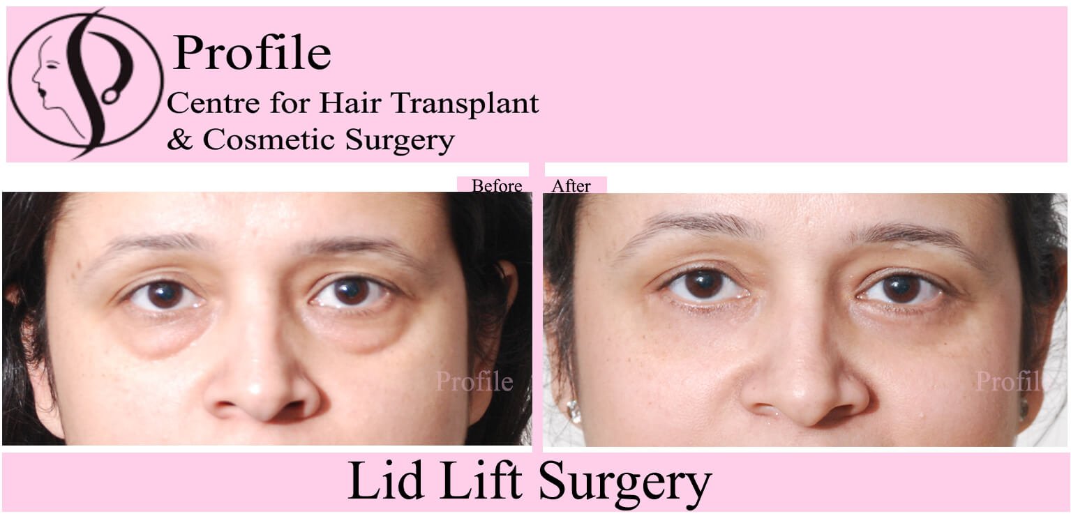 blepharoplasty12 (1)