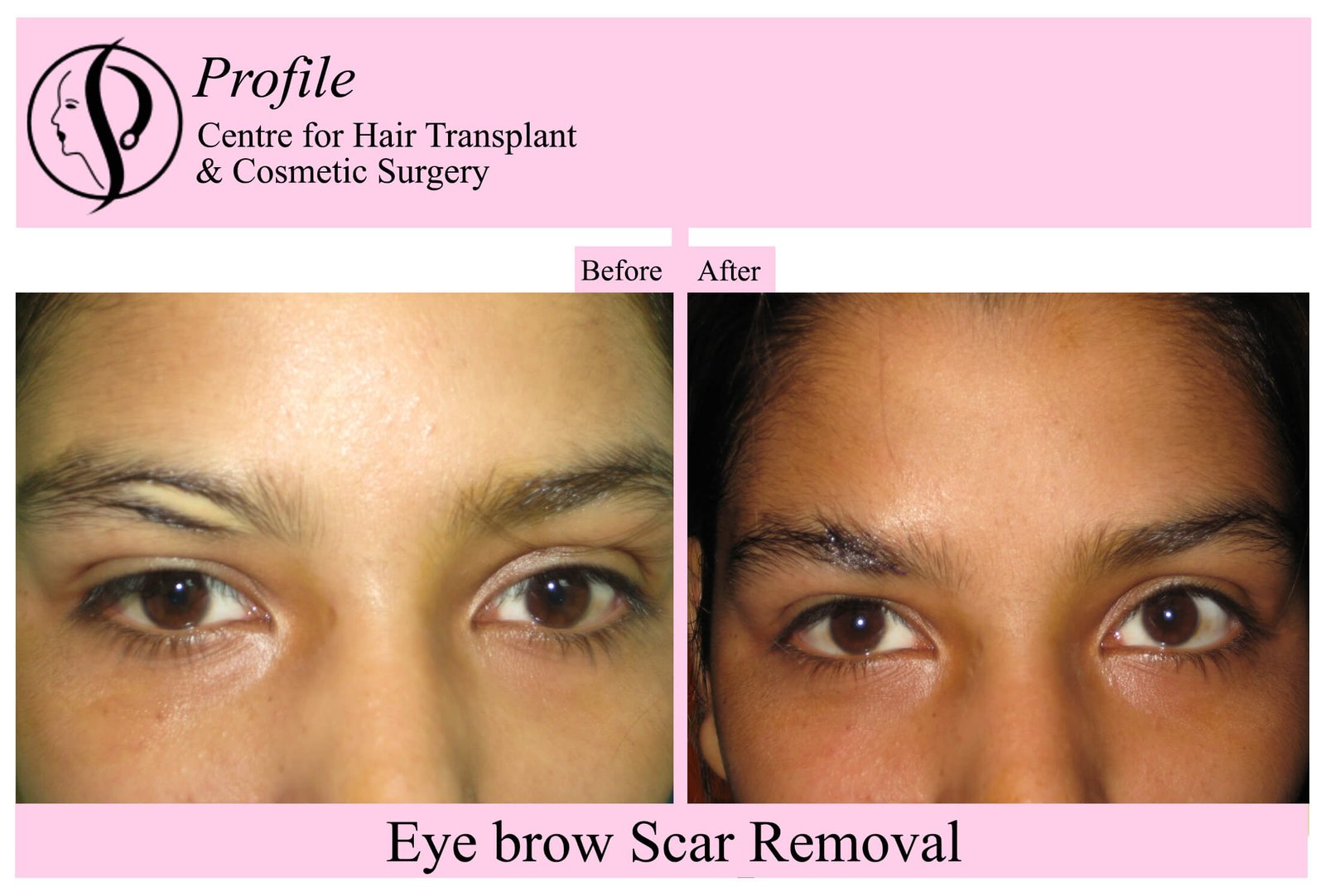 eye brow scar
