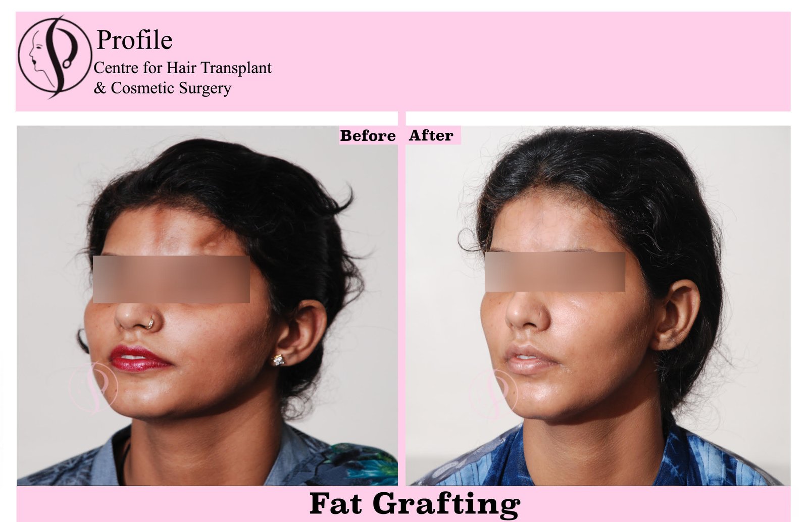 fat_grafiting