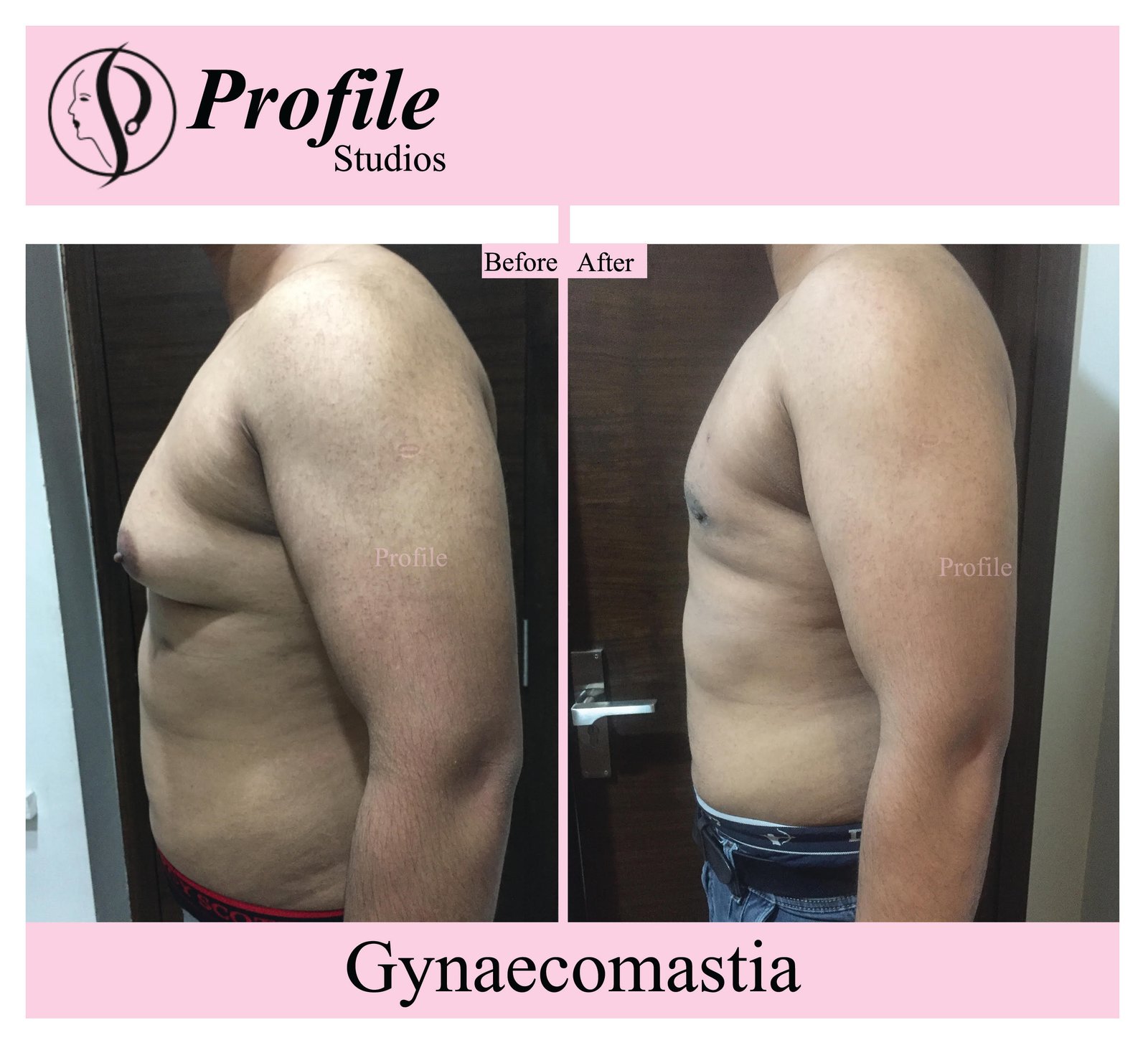 gynaecomastia 1