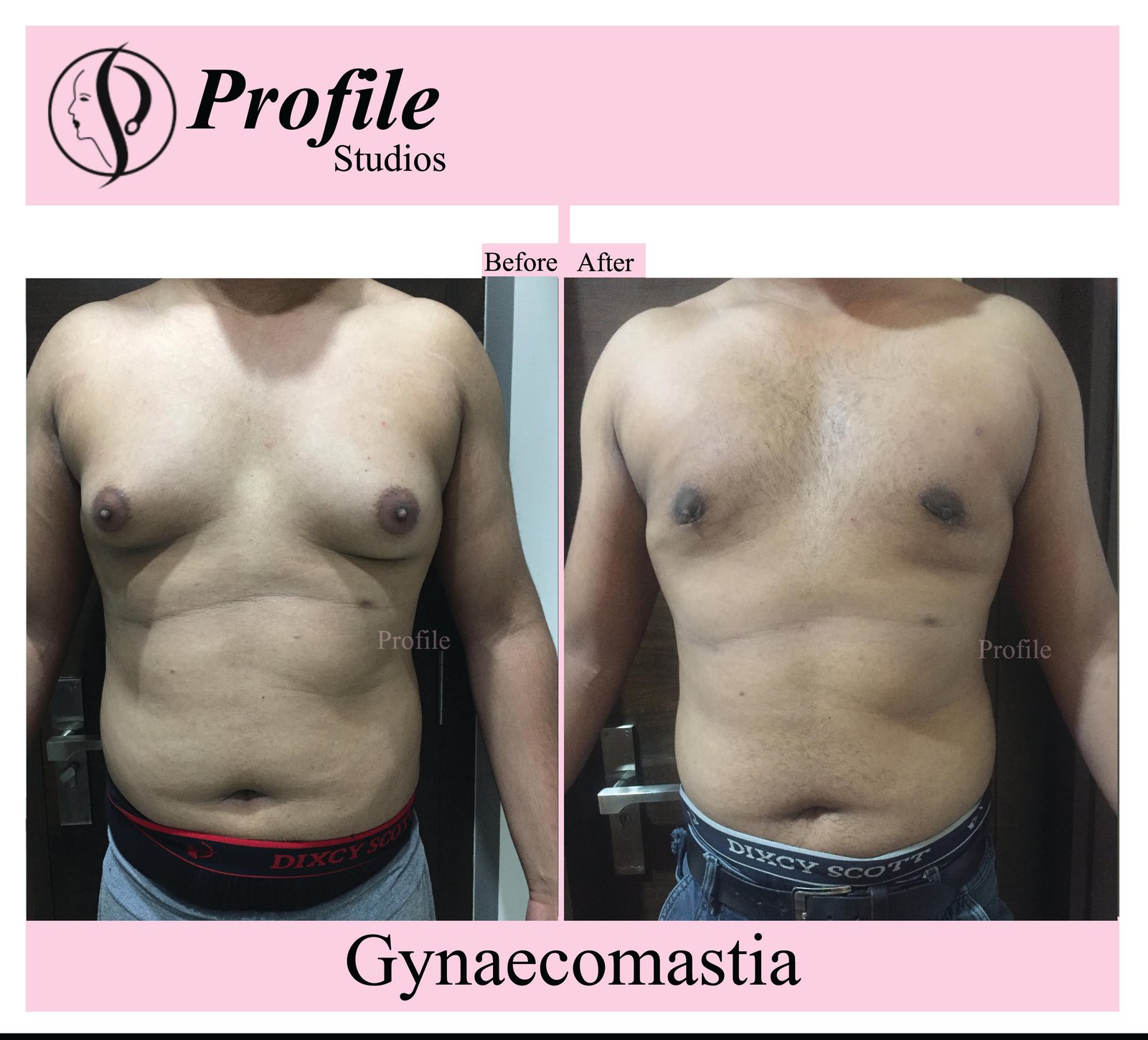 gynaecomastia 2