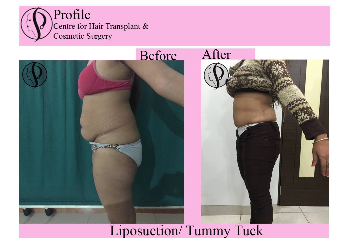 lipo tummy