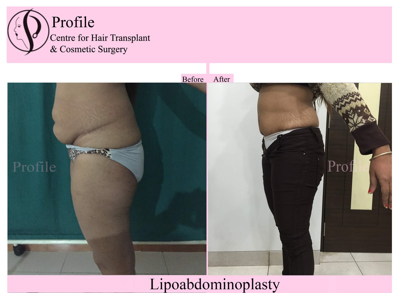 lipoabdomen