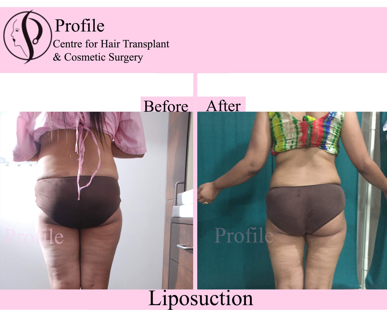 lipofemale