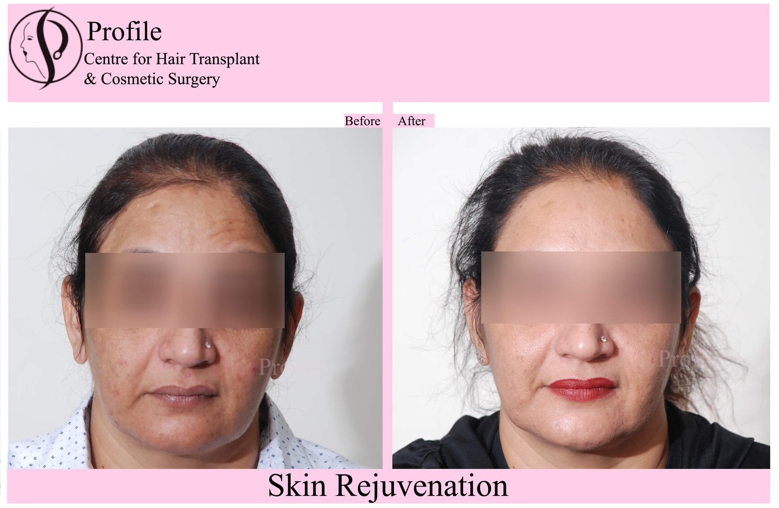 skin rejuvenation