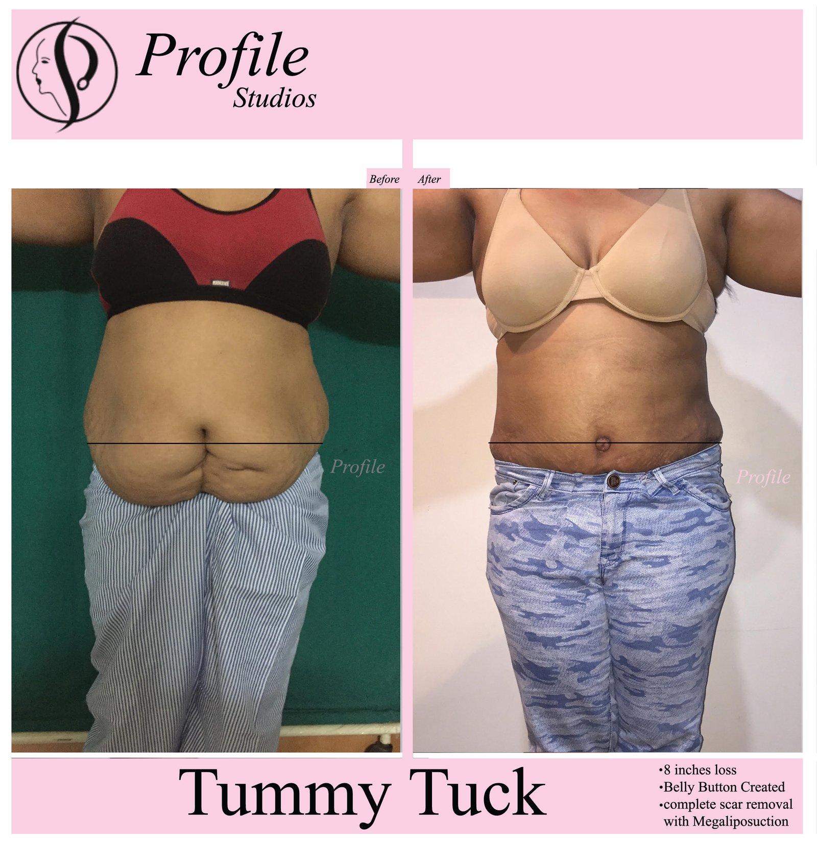 tummy_tuck1