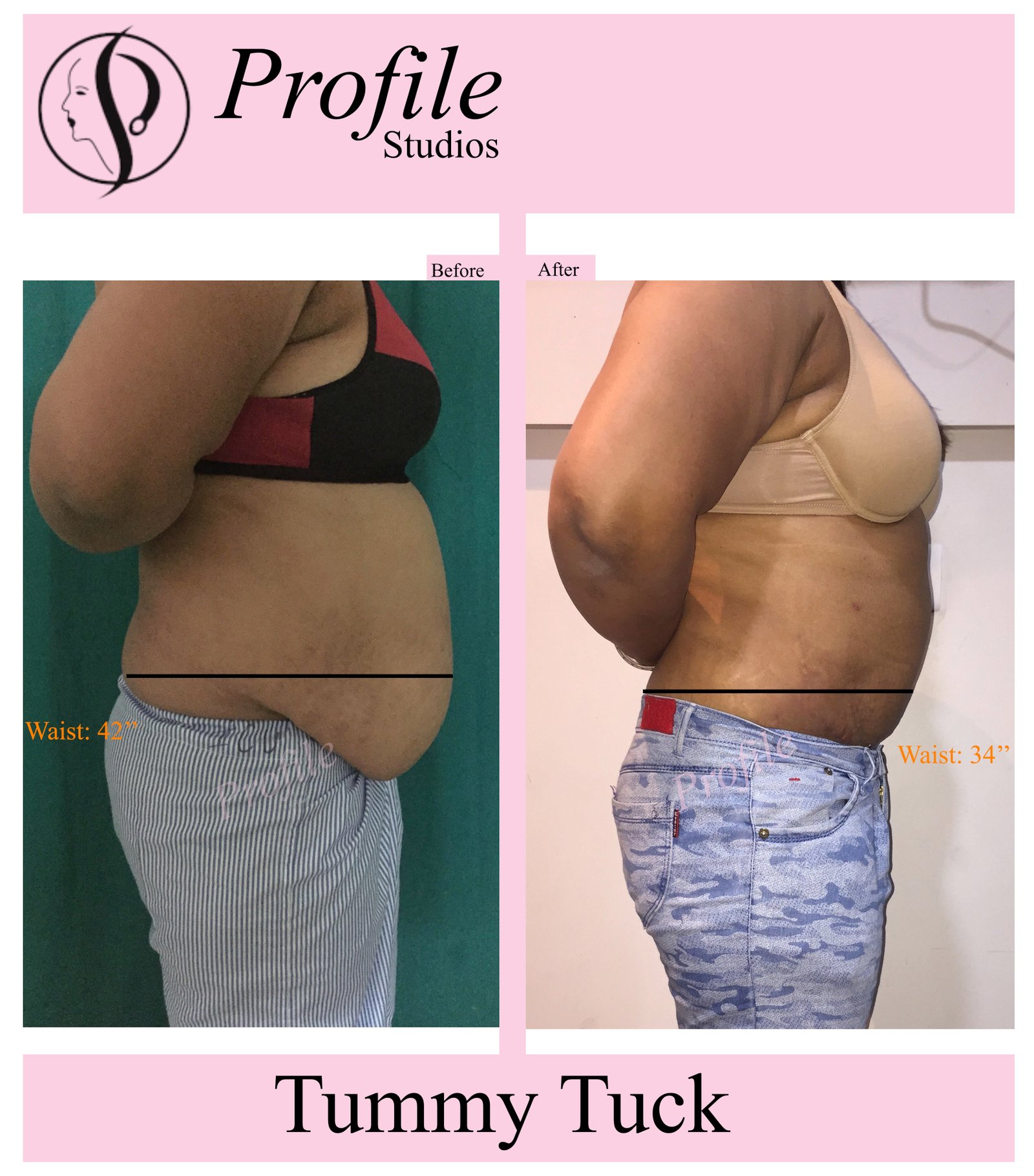 tummy_tuck2