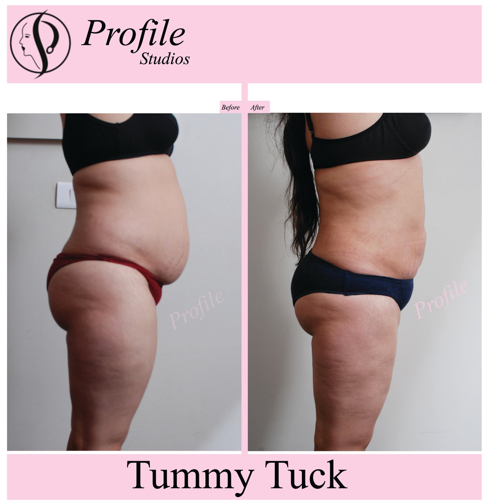 tummy_tuck3