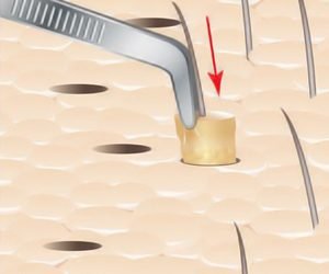 GRAFT IMPLANTATION