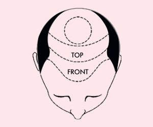 Hair Transplant