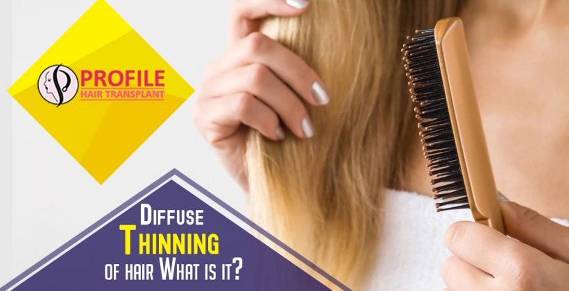 Diffuse Thinning of Hair What is it?
