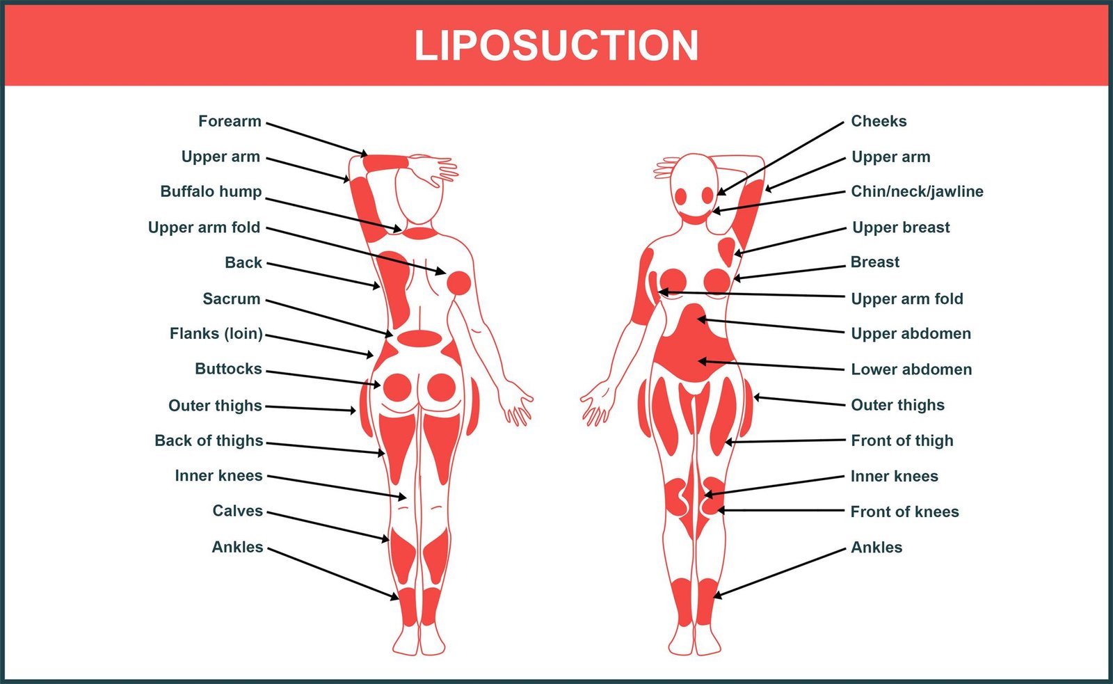 Liposuction 1