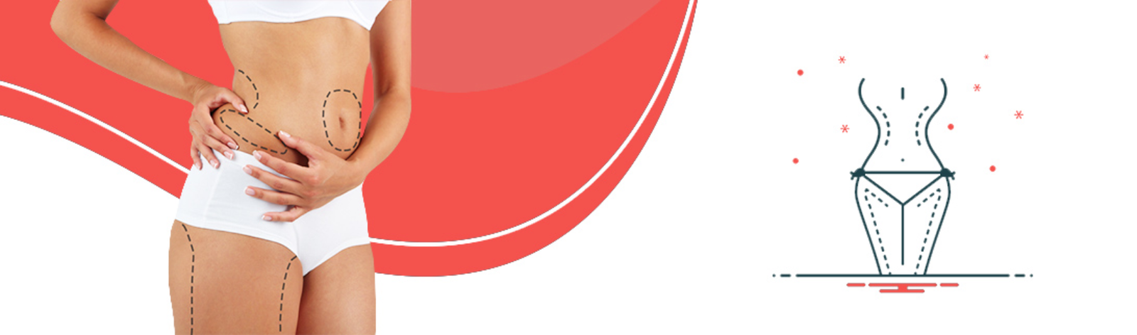 Liposuction