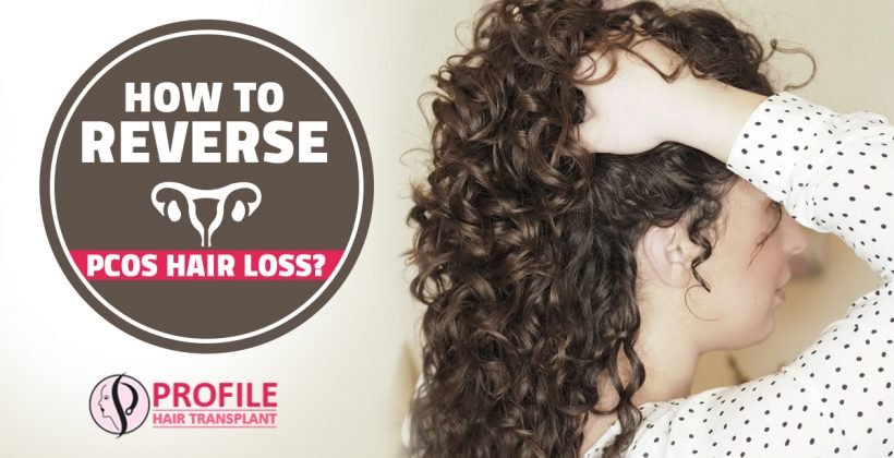 How to Reverse PCOS Hair loss?