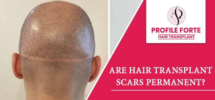 What are the procedures to remove the scar left by the hair transplant?