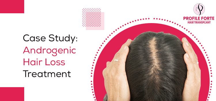 A Detail Analysis Of Hair Loss And Its Transplant Treatment
