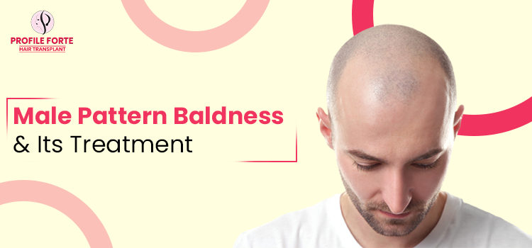 What Is Male Pattern Baldness, Its Common Causes And Treatment?