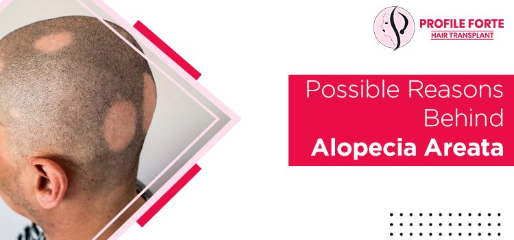 Hair Loss: What are the possible reasons behind alopecia areata?