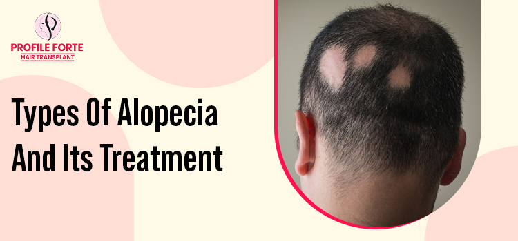 What are the types of alopecia, and how to find the right treatment? What are the types of alopecia, and how to find the right treatment?